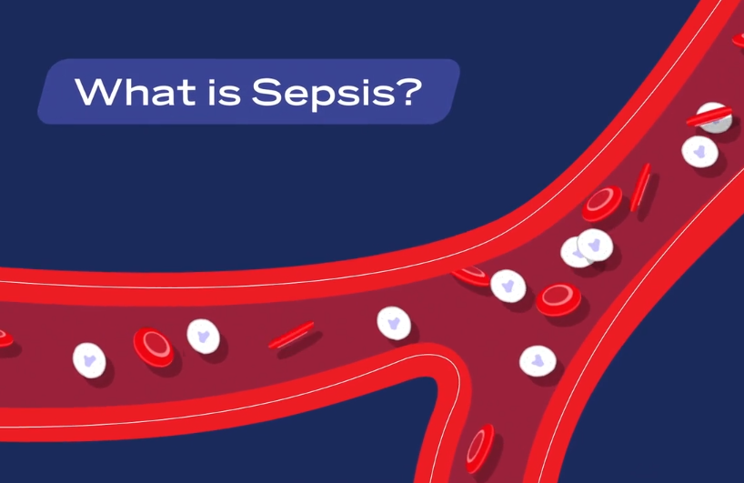 illustration of blood artery with label, "What is Sepsis?"